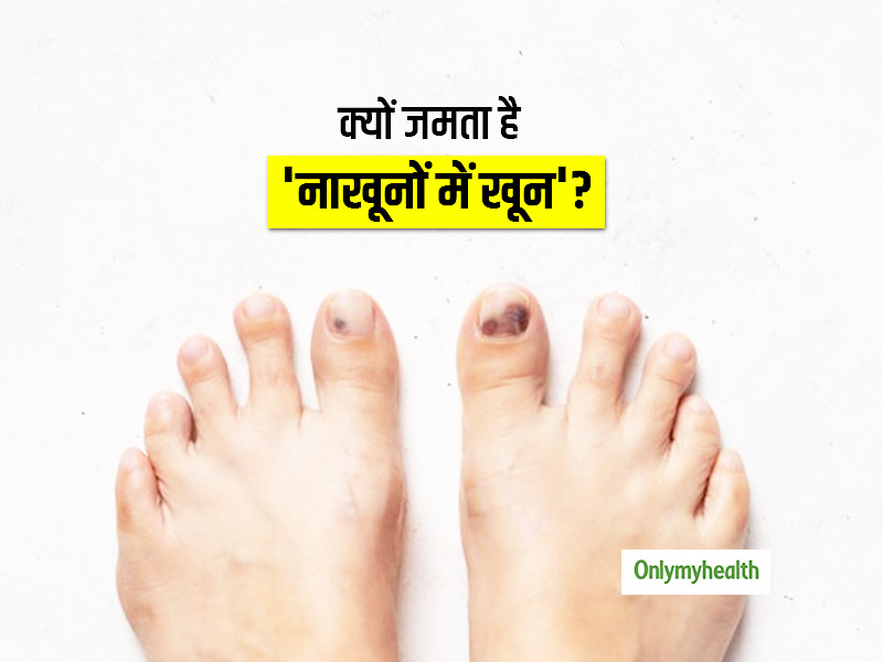 Subungual Hematoma: क्यो जमता है 'नाखूनों में खून'? जानें लक्षण और उपचार