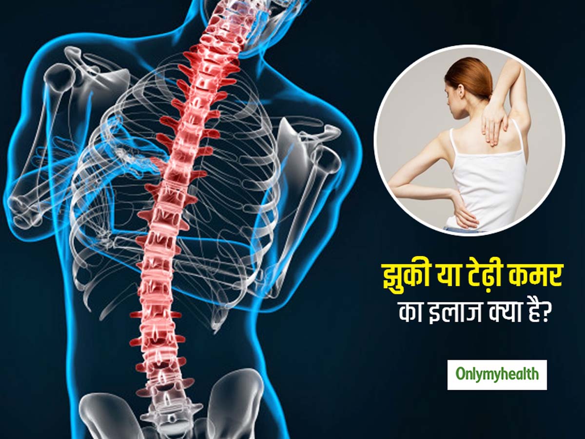 Scoliosis or Curved Spine Symptoms Causes and Treatment in Hindi | कमर  झुकने या रीढ़ की हड्डी में टेढ़ेपन (स्कोलियोसिस) का कारण, लक्षण और इलाज |  Onlymyhealth | Onlymyhealth
