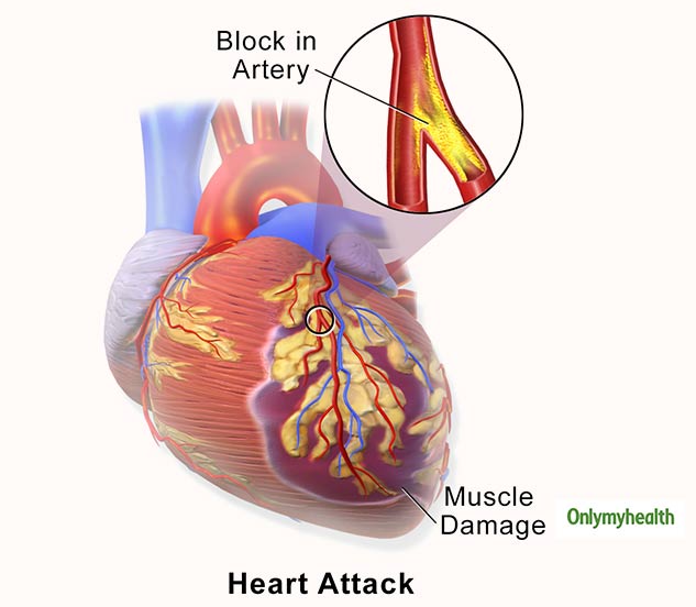 Coronary Calcium Scan Know The Purpose And Risks Related To This Heart 