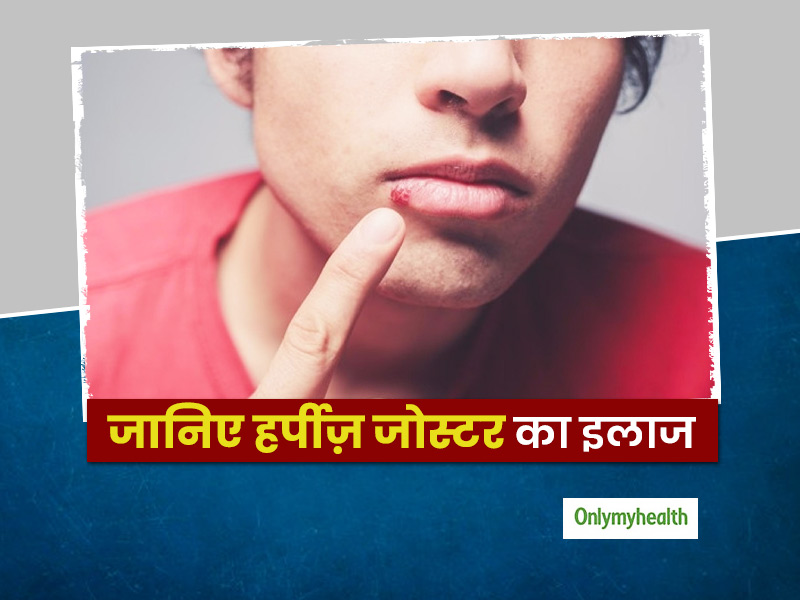 हर्पीज़ (शिंगल) के बारे में क्या जानते हैं आप? जानिए इसके कारण, लक्षण और घरेलू उपचार