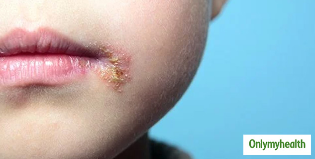 herpes