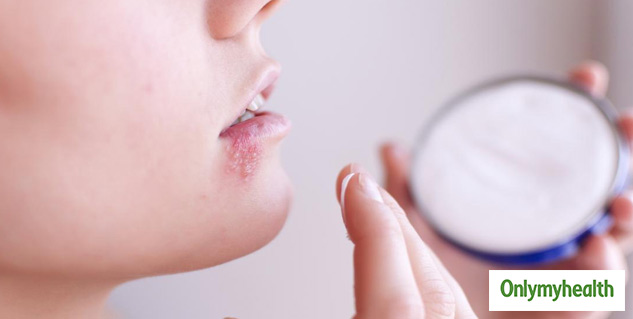 treatment of herpes