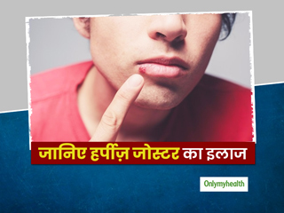 हर्पीज़ (शिंगल) के बारे में क्या जानते हैं आप? जानिए इसके कारण, लक्षण और घरेलू उपचार