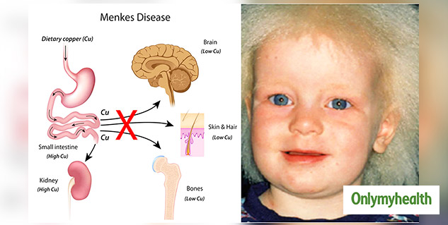 Menkes Steely Hair Syndrome