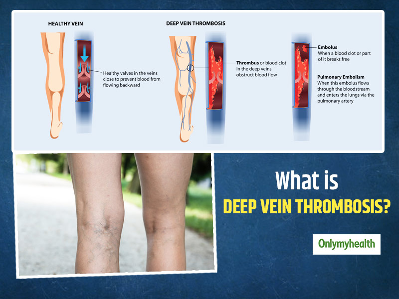 What Is Deep Vein Thrombosis (DVT)? Here Are Its Symptoms, Causes, Treatment And Risk Factors