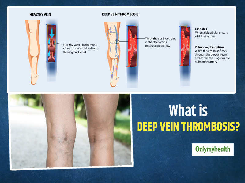 deep vein thrombosis test