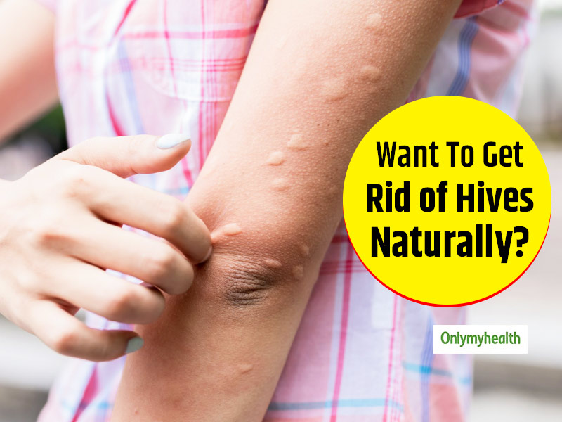 Irritated With Hives? Try These Effective Natural Remedies