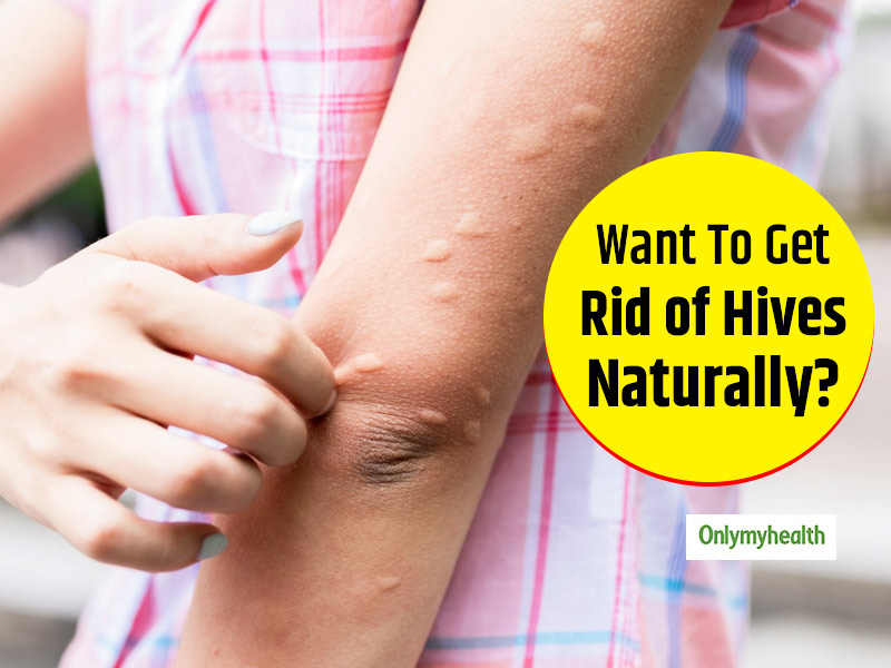 What Stops Hives From Itching Naturally at Tiffany Evans blog