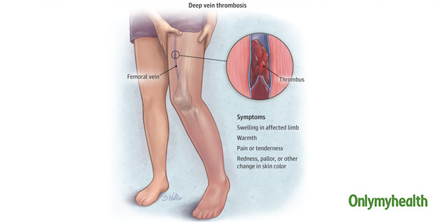Deep Vein Thrombosis, Symptoms and Causes