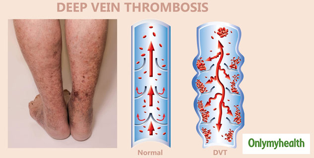 What Is Deep Vein Thrombosis (DVT)? Here Are Its Symptoms, Causes