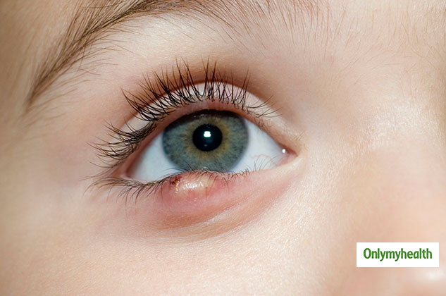insideeyelidpimples