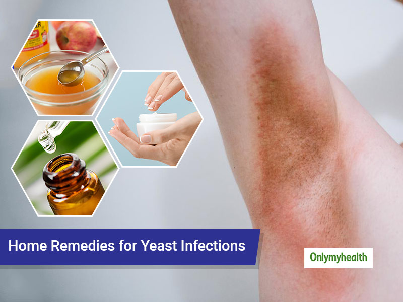 How to treat on sale yeast infection