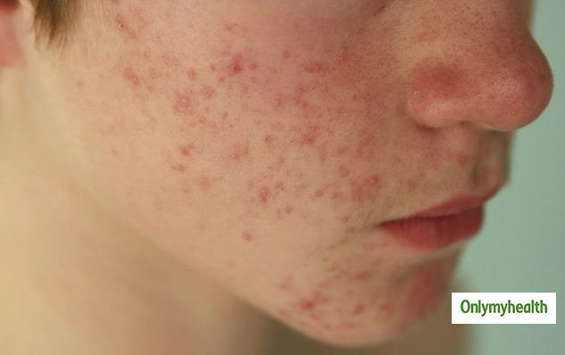 causes-of-red-spots-acne-or-pimples-on-face-and-dermatologist-tips-to