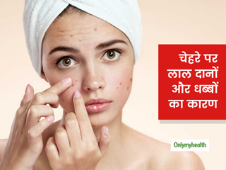 चेहरे पर लाल दाने और धब्बे उभरने के क्या कारण हो सकते हैं? डॉक्टर से जानें इससे बचाव के लिए टिप्स