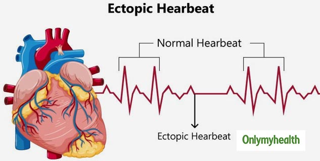 ectopic beats symptoms