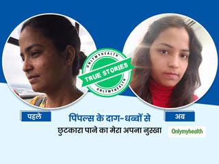 पिंपल्स और चेहरे के दाग-धब्बों को दूर करने के लिए मैंने आजमाया ये बेहद आसान सा नुस्खा, आप भी करें ट्राई