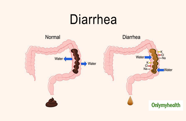 Is It Possible To Have Diarrhoea And Constipation Together Learn About Paradoxical Diarrhoea
