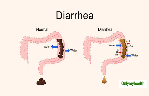 overflow diarrhea