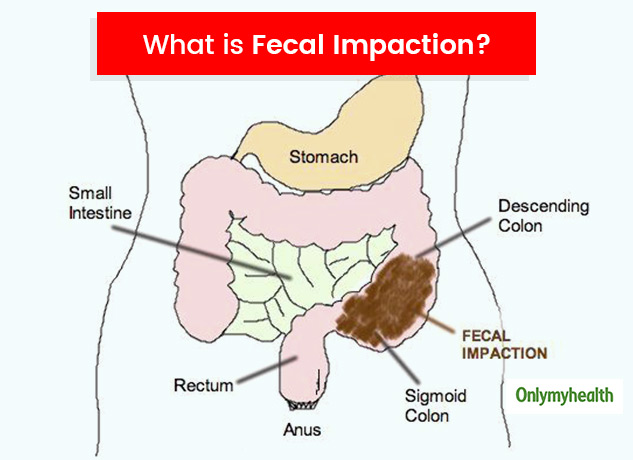 Faecal impaction with overflow