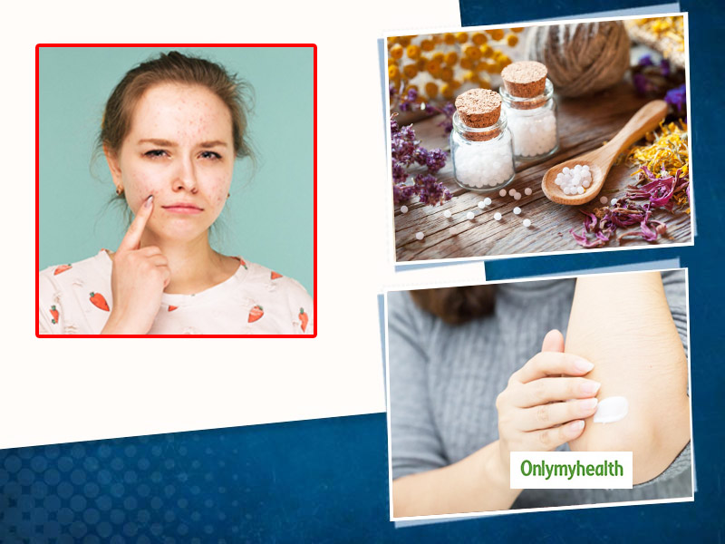 Eczema Treatment: 10 Homoeopathic Remedies To Deal With Itchy Inflammation Of Skin