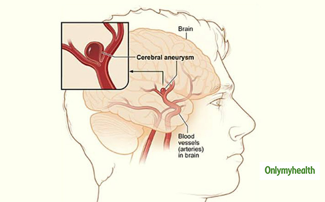 How to know if you have a brain aneurysm