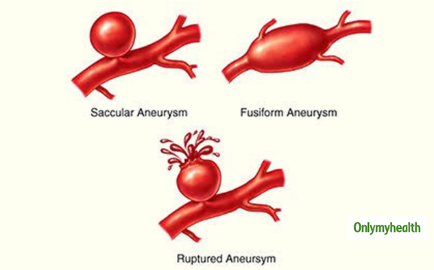 What Is A Brain Aneurysm? Here's Everything You Need To Know From A ...