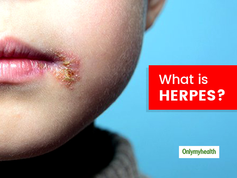 What Is Herpes Know Its Types Causes Signs And Treatment From A 