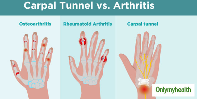 Rheumatoid Arthritis Treatment Get Rid Of This Autoimmune