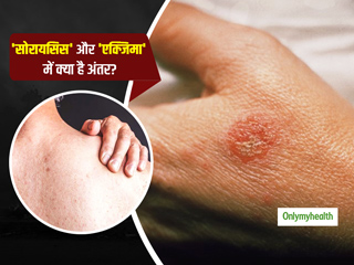 खुजली, चकत्ते और त्वचा पर सफेद पपड़ी हैं सोरायसिस और एक्जिमा दोनों का लक्षण, फिर दोनों में क्या है अंतर?