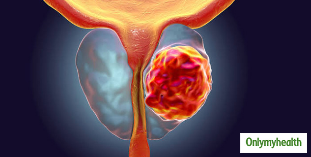 prostate-cancer-symptoms-causes-stages-diagnosis-and-treatment