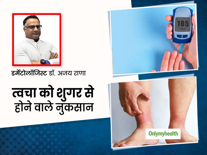 Diabetes: ज्यादा मीठा खाने से हो सकती हैं त्वचा संबंधी ये 6 दिक्कतें, जानें स्किन को शुगर से होने वाले नुकसान 