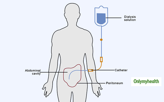 Peritoneal Dialysis Pd Everything About Its Need Risks And Side