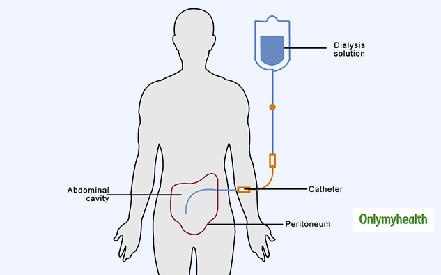 peritoneal-dialysis-pd-everything-about-its-need-risks-and-side