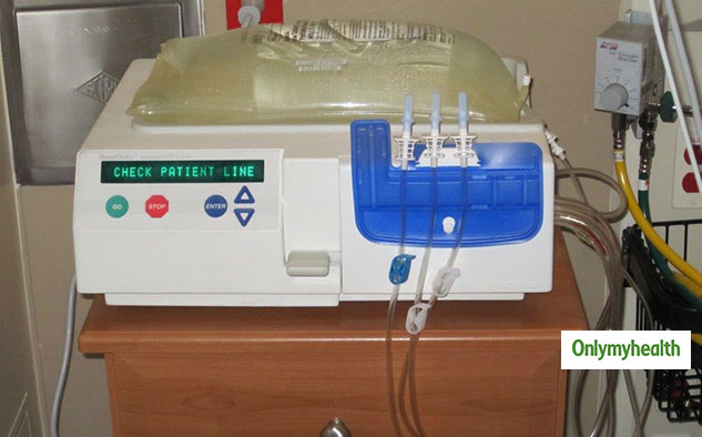 peritoneal-dialysis-pd-everything-about-its-need-risks-and-side
