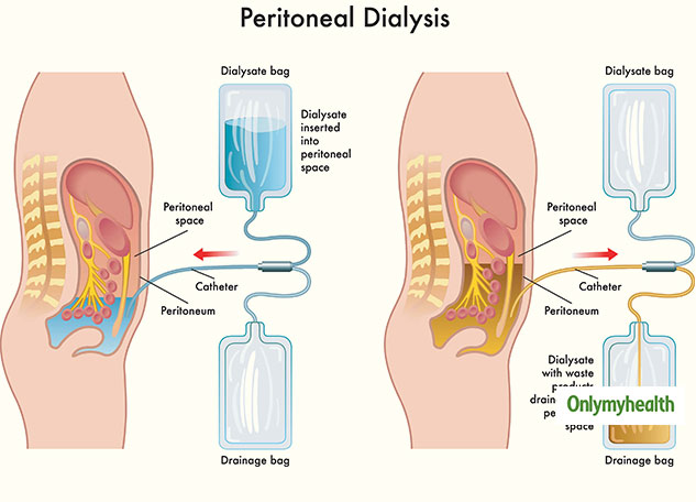 peritoneal-dialysis-pd-everything-about-its-need-risks-and-side