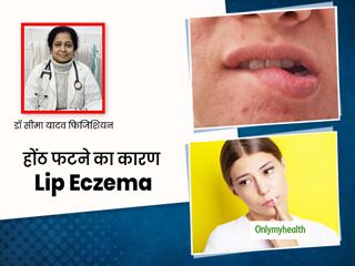 फटे होंठ या होंठों की सूजन हो सकते हैं एक्जिमा के लक्षण, डॉक्टर से जानें इसका कारण और इलाज