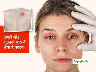 स्किन पर ऊभरी और गुलाबी गांठ हो सकती है इस बीमारी की निशानी, जानिए इसके लक्षण, कारण और उपचार