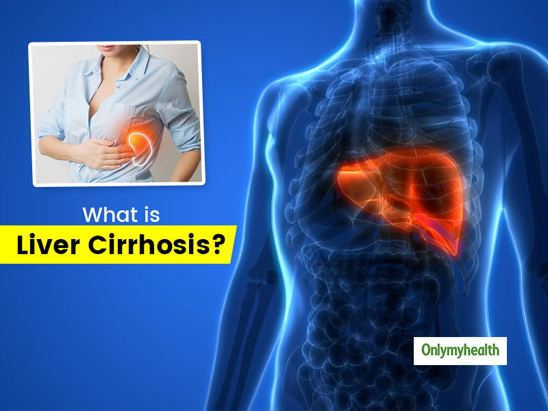 What Is Liver Cirrhosis? Know Its Causes, Symptoms and Prevention