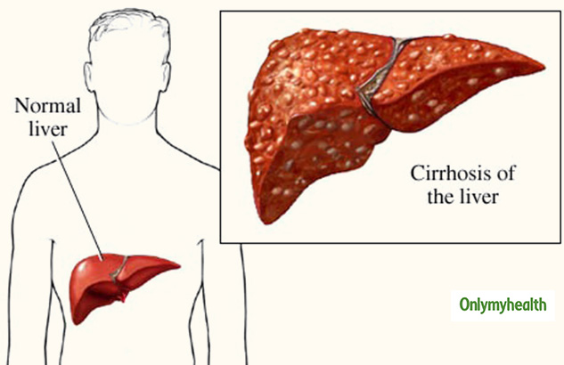 What Is Liver Cirrhosis Know Its Causes Symptoms And Prevention Onlymyhealth