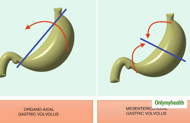 What Is A Slipped Disc? Here Are Its Signs, Causes Treatment And