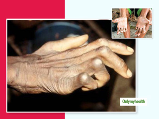 कितना संभव है कुष्ठ रोग (Leprosy) के लिए घेरलू उपाय, जानें क्या है इसका सही इलाज।