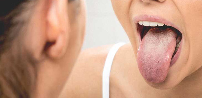 Tongue Cancer Symptoms Causes Treatment Onlymyhealth