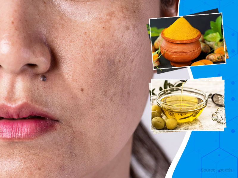 8 Home Remedies To Treat Skin Pigmentation