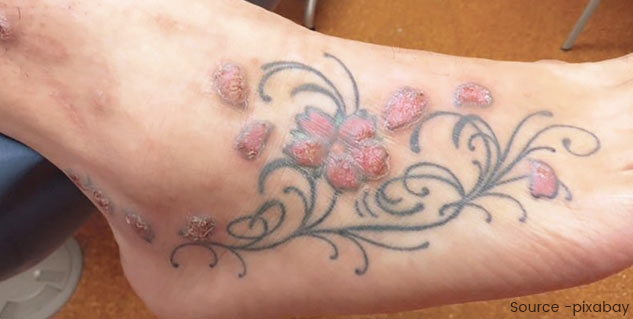 Tattoo Infection: How To Identify And Prevent This Infection