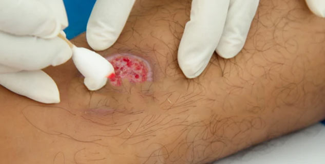 Tattoo Infection: How To Identify And Prevent This Infection
