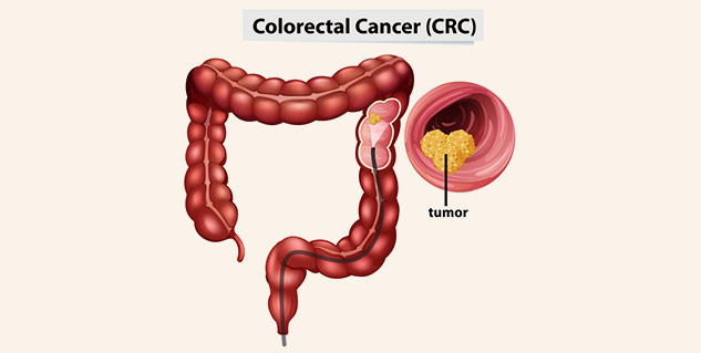 Risk of Colorectal Cancer