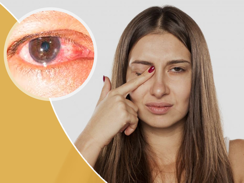 Redness and Pain in Eyes Could Be Keratitis, Know More About This Eye Disease