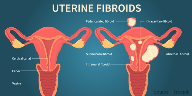 Do Not Ignore Bleeding After Menopause It Could Be A Sign Of Uterine