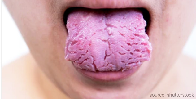 Inside3_Fissuredtongue