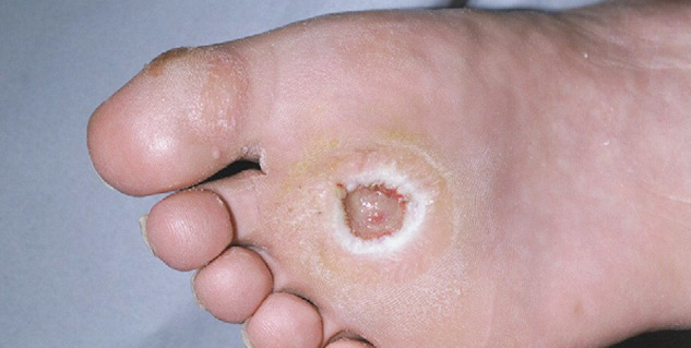 Diabetic Foot Ulcer